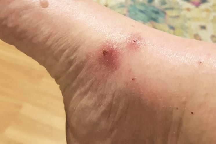 What Is Ross River Virus?